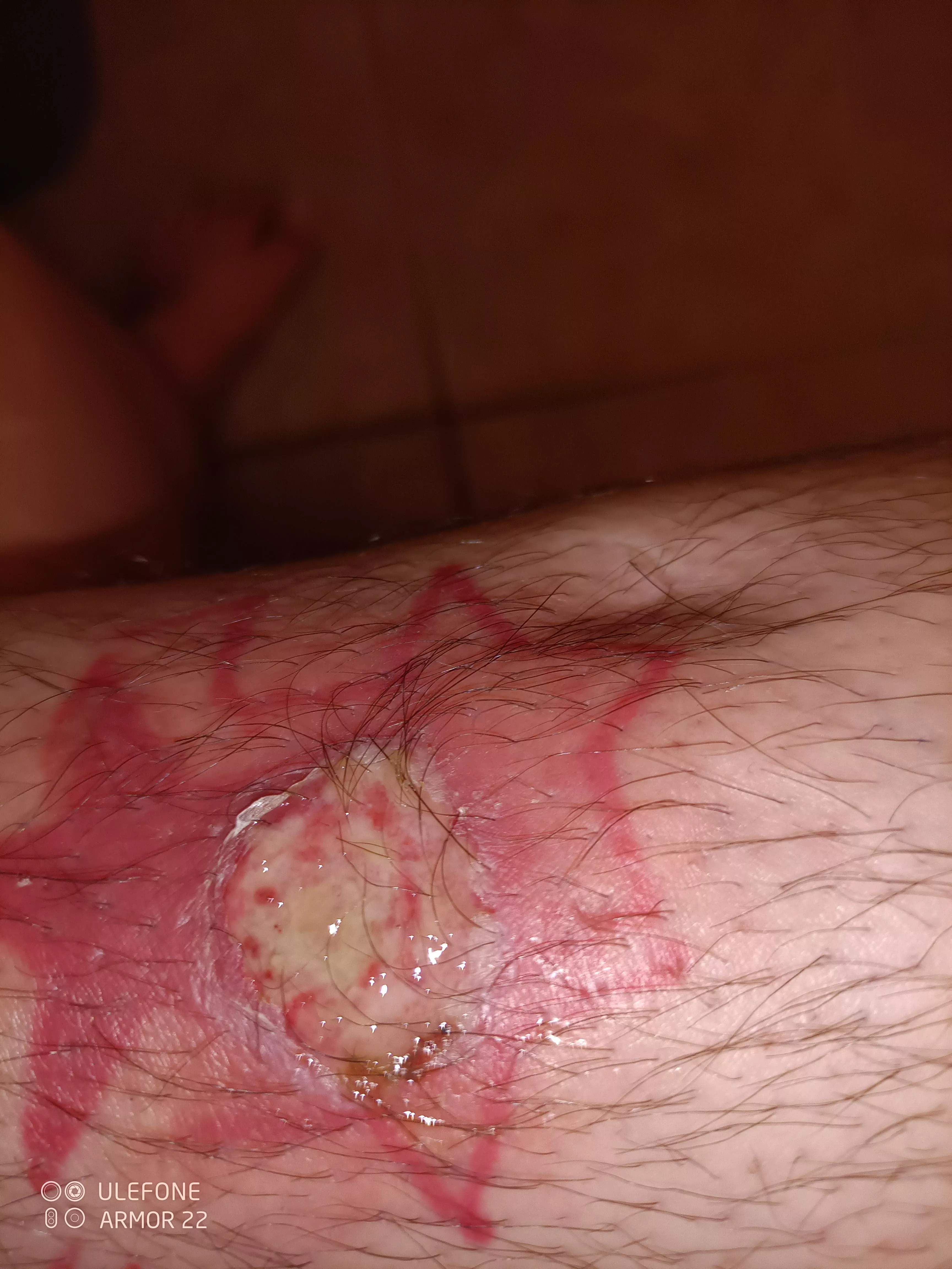 Rotting leg girl here, shit went bad. Almost about to excise this myself.