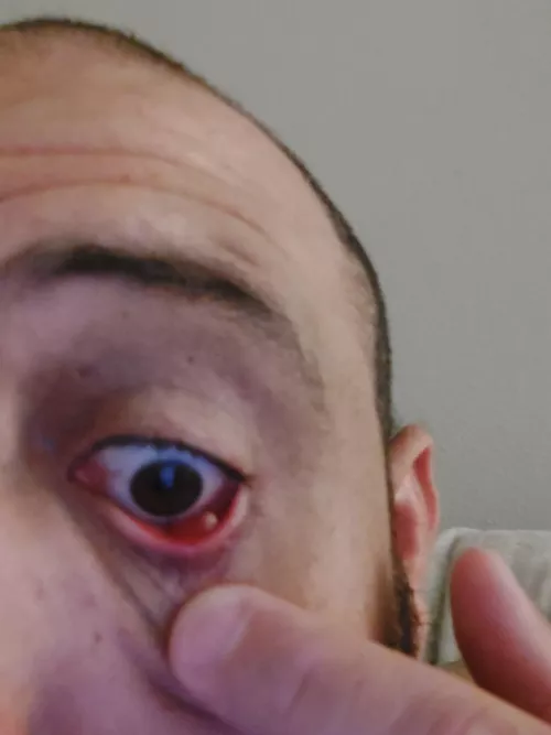 Inner stye driving me crazy