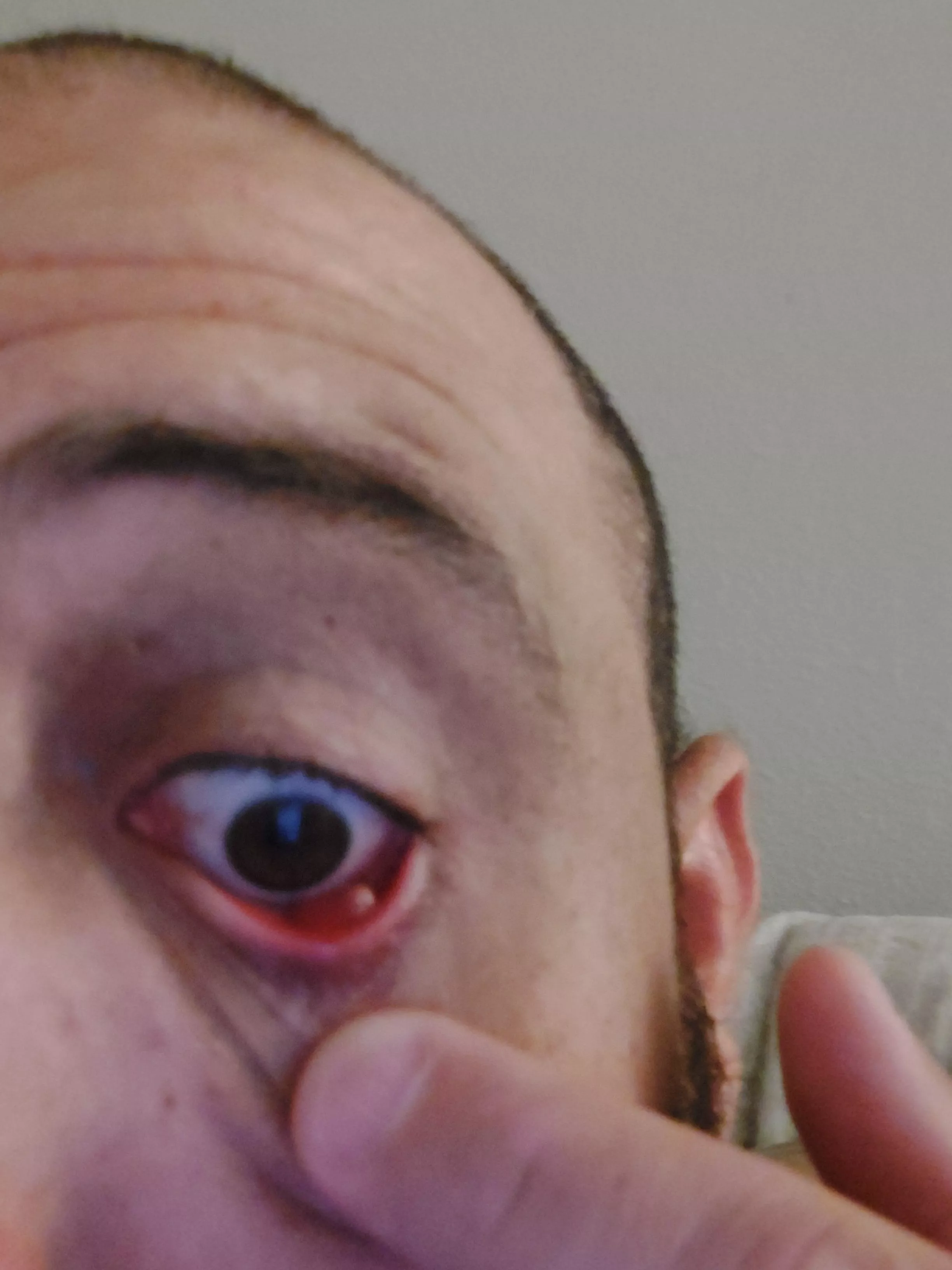 Inner stye driving me crazy