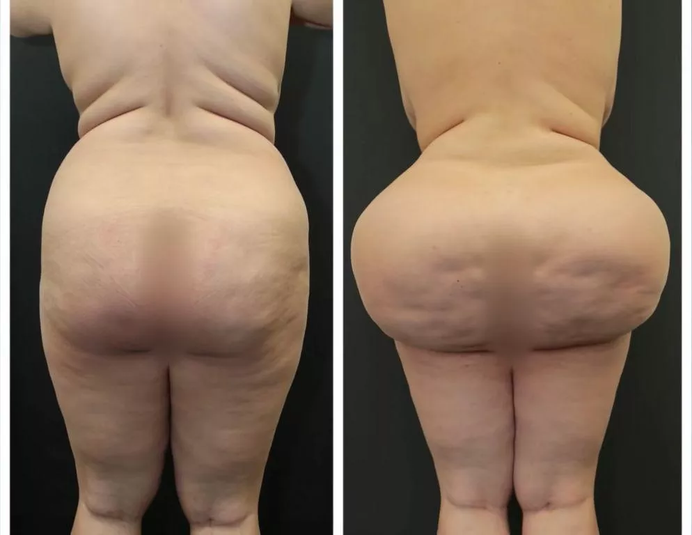 BBW with BBL, before and after