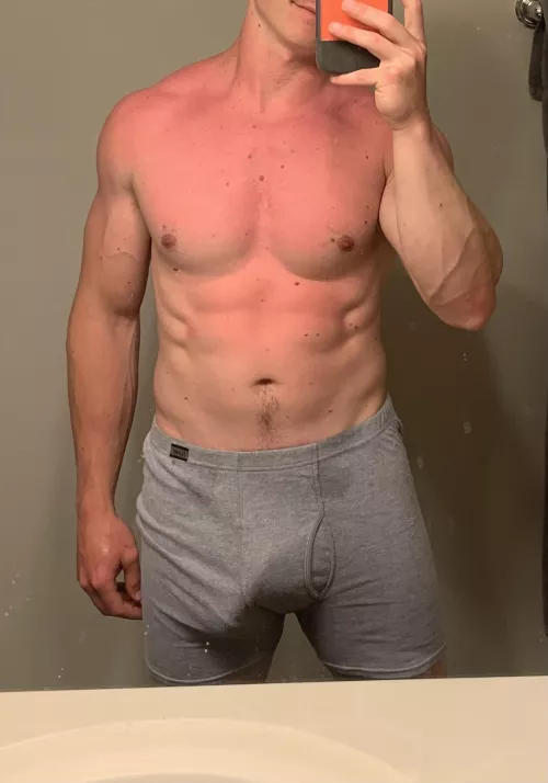 Accidentally got burned by the pool (29)