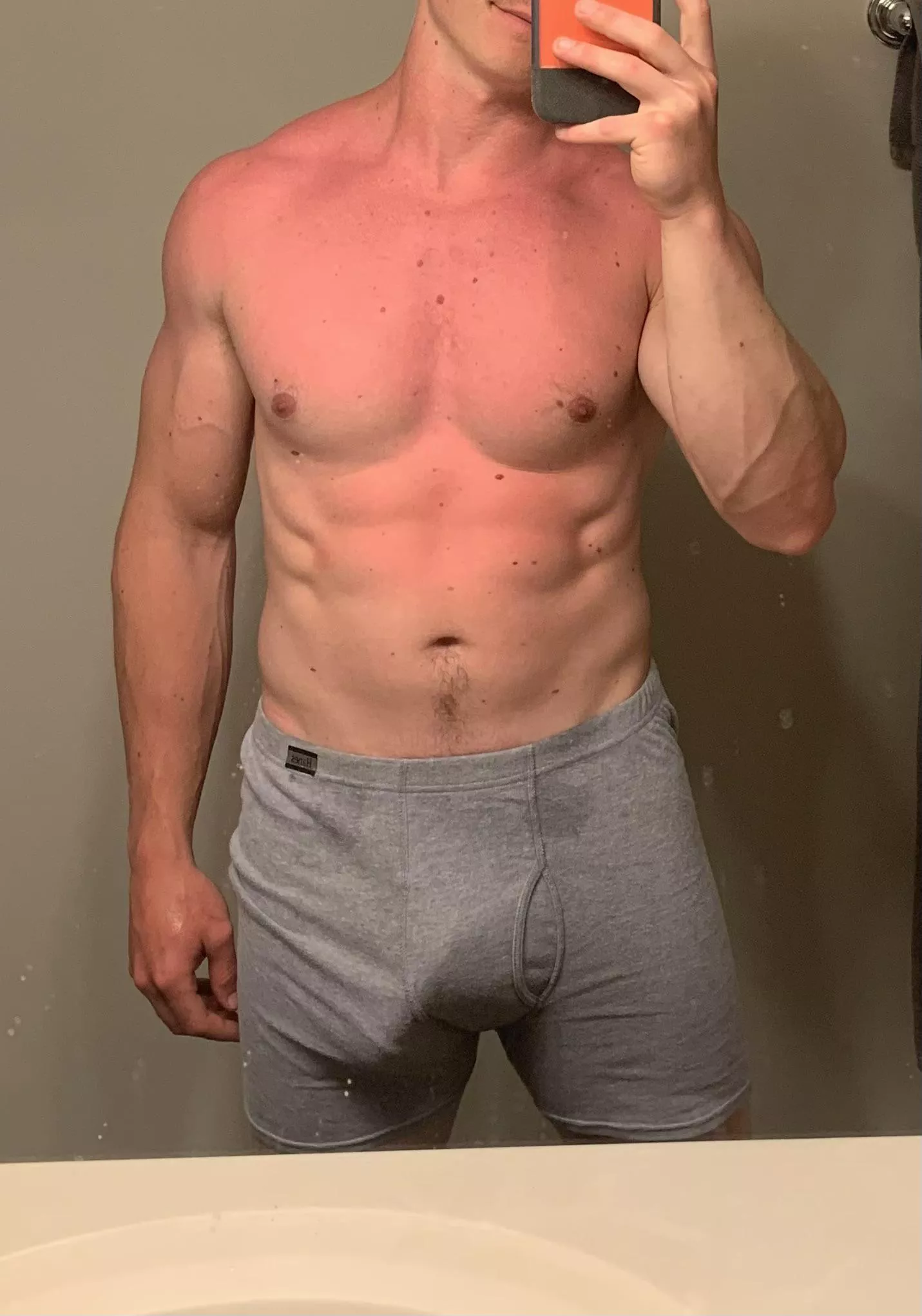 Accidentally got burned by the pool (29)