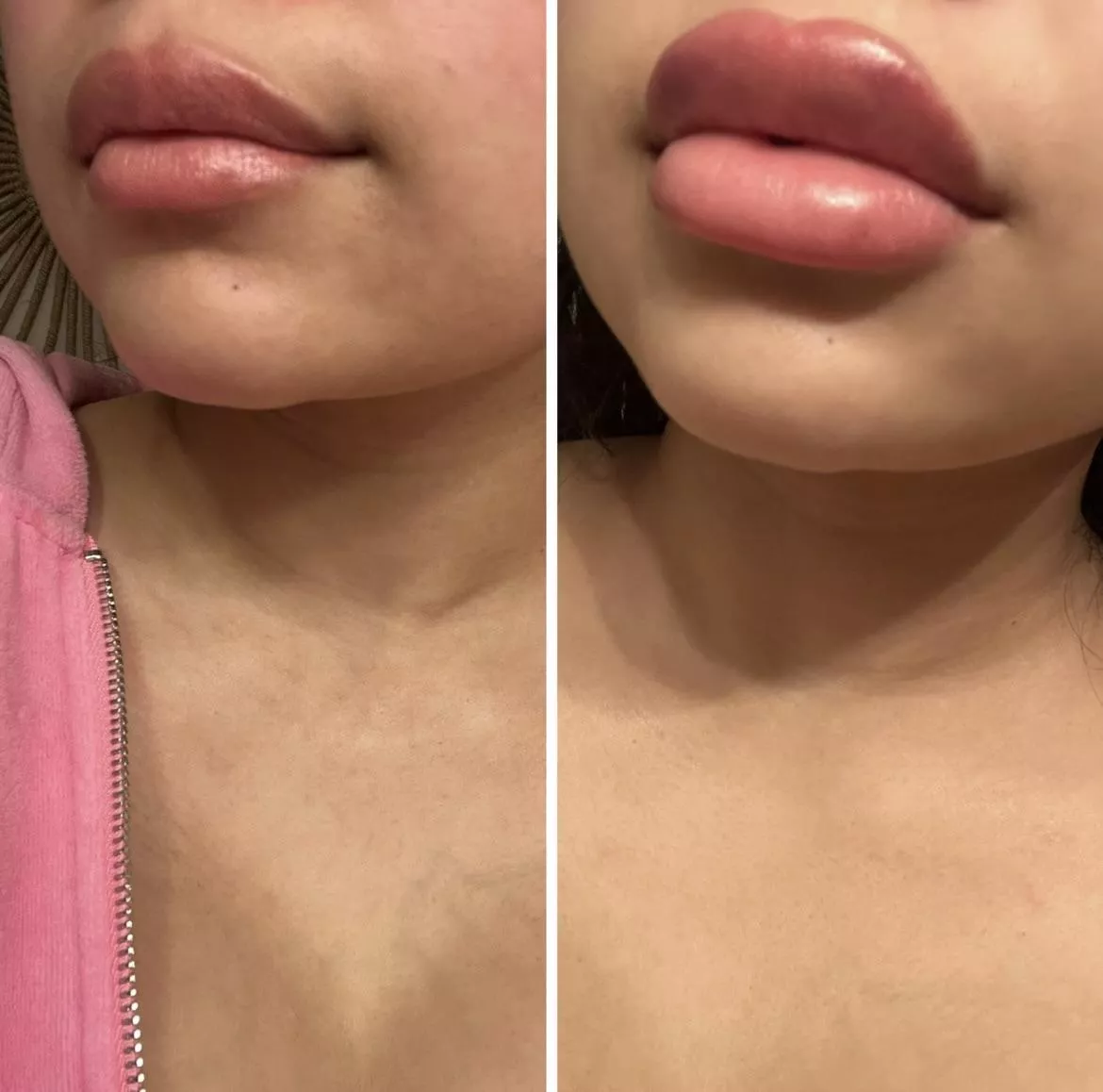 Lip filler progress! Can’t wait for more
