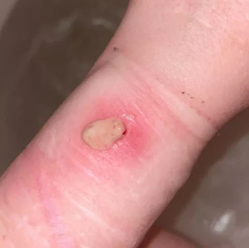 Staph infection boil exploded after 4 days, never ending nasty stuff flowed out