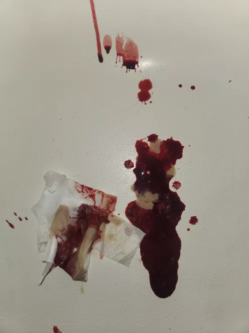 Huge amount of discharge from bartholin abcess