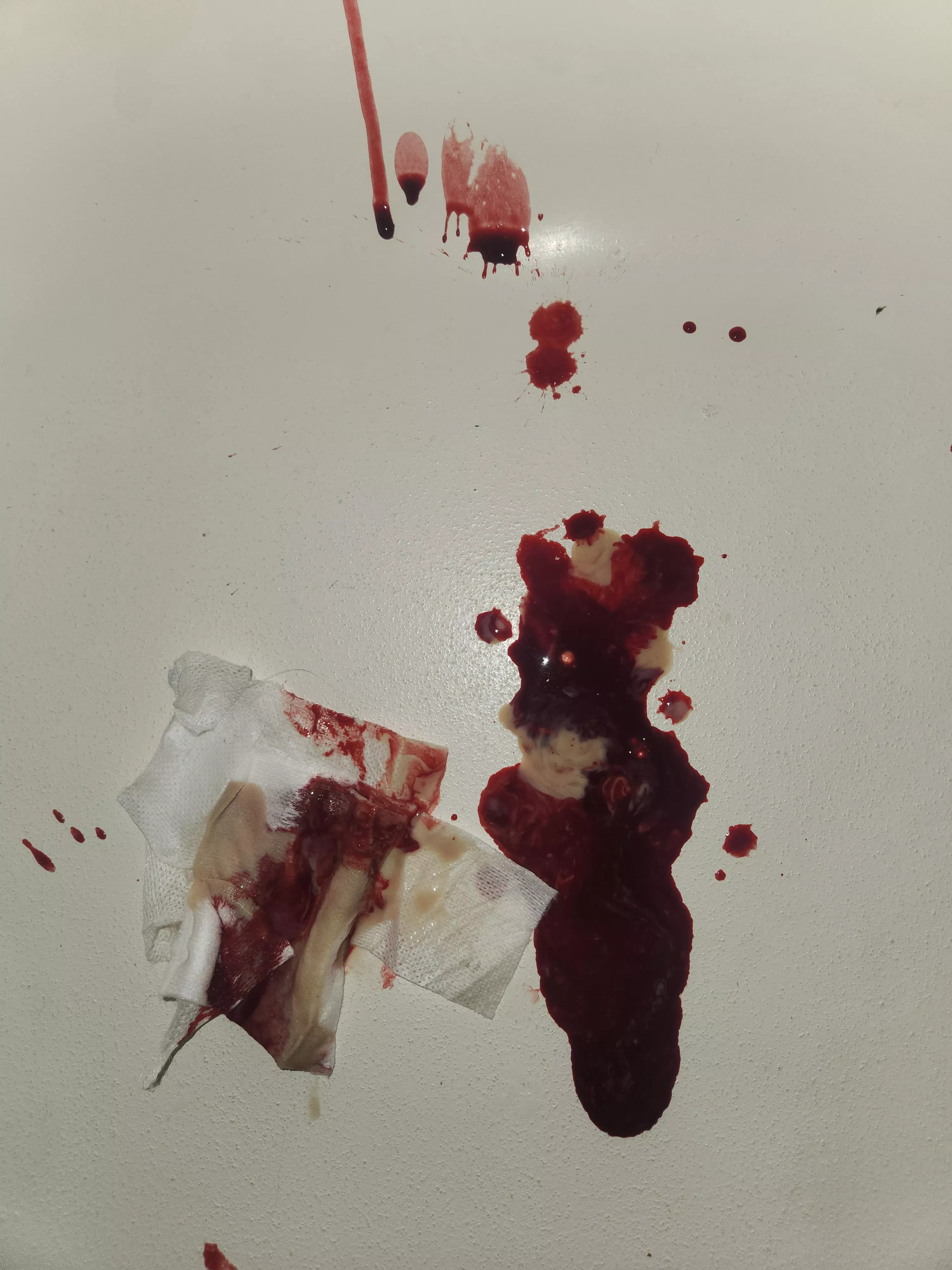 Huge amount of discharge from bartholin abcess