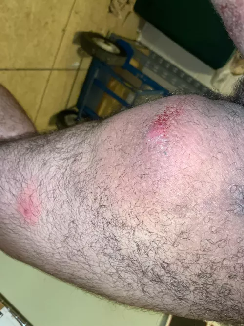 Popped this morning. Feels better but still not 100%