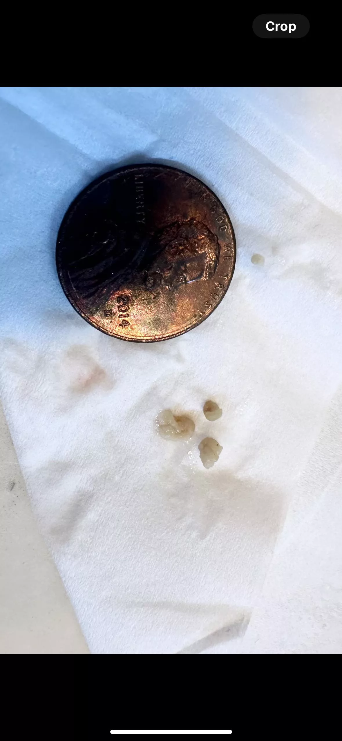 Tonsil stones FINALLY came out!