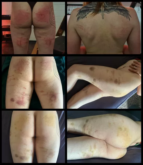 Bruises - The Gift That Keeps on Giving