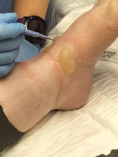 Massive blisters due to a hot water burn.