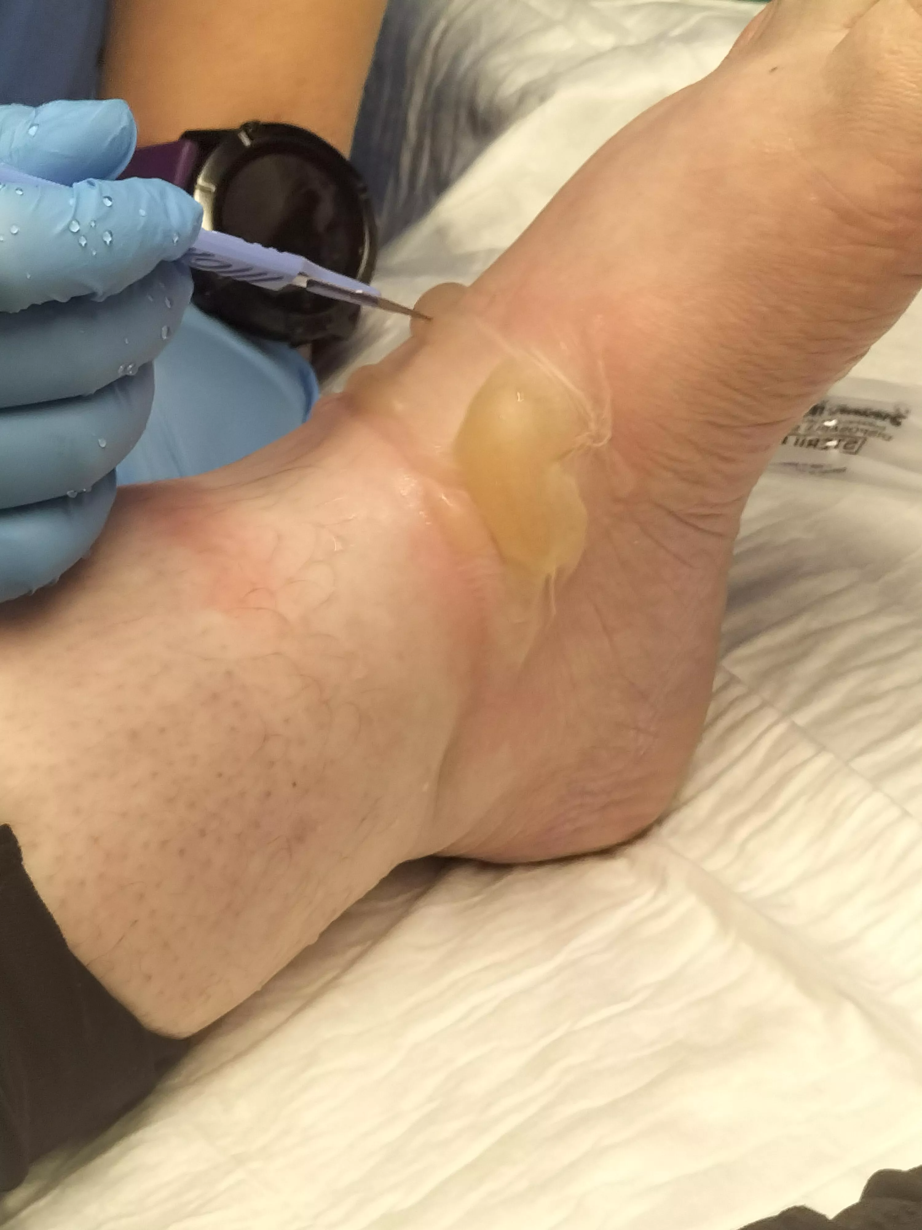 Massive blisters due to a hot water burn.