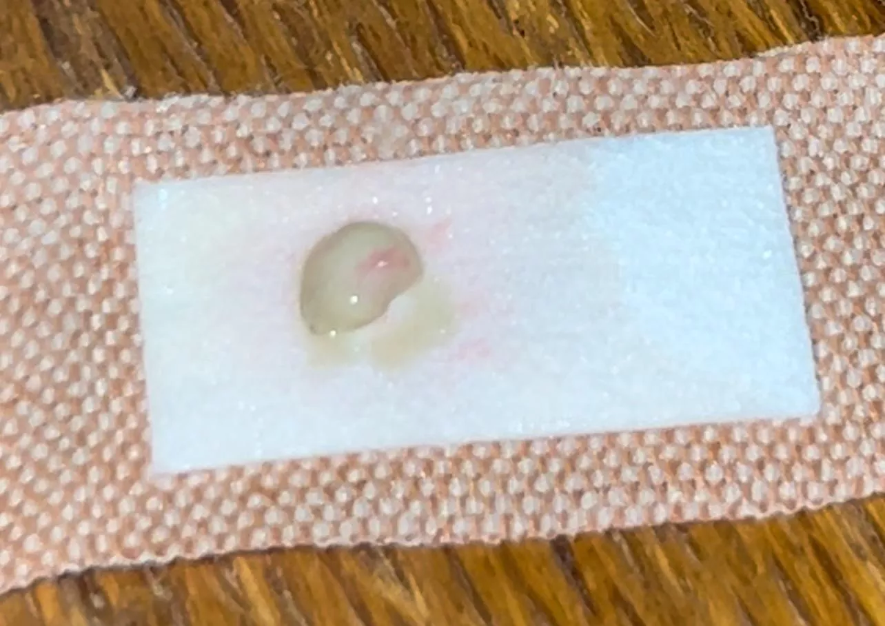 New one for me… an entire, unbroken abscess sac in one piece. Yes, I did my own alien autopsy on it later.