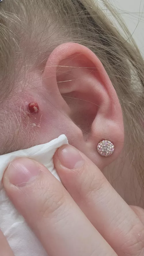 Well guess my MRSA came back again, she is angry 😅