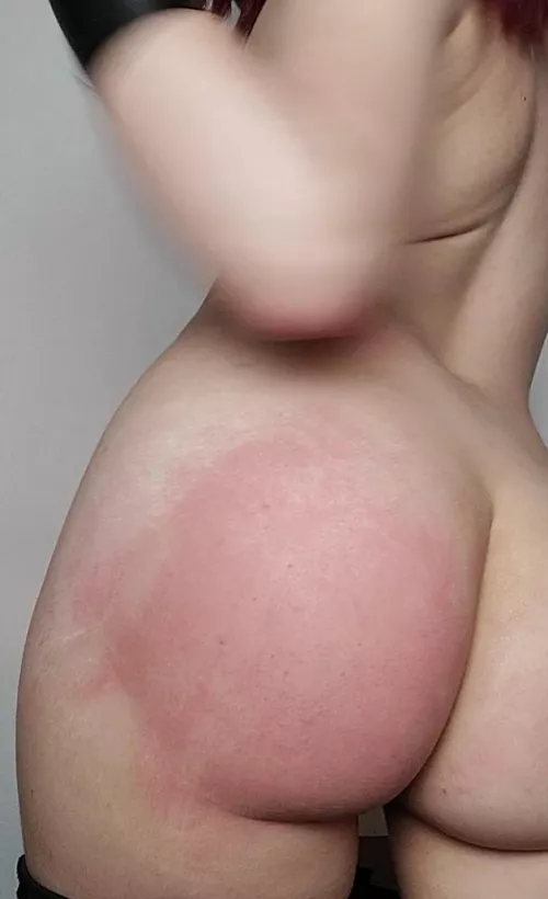 I hope it doesn't bruise...