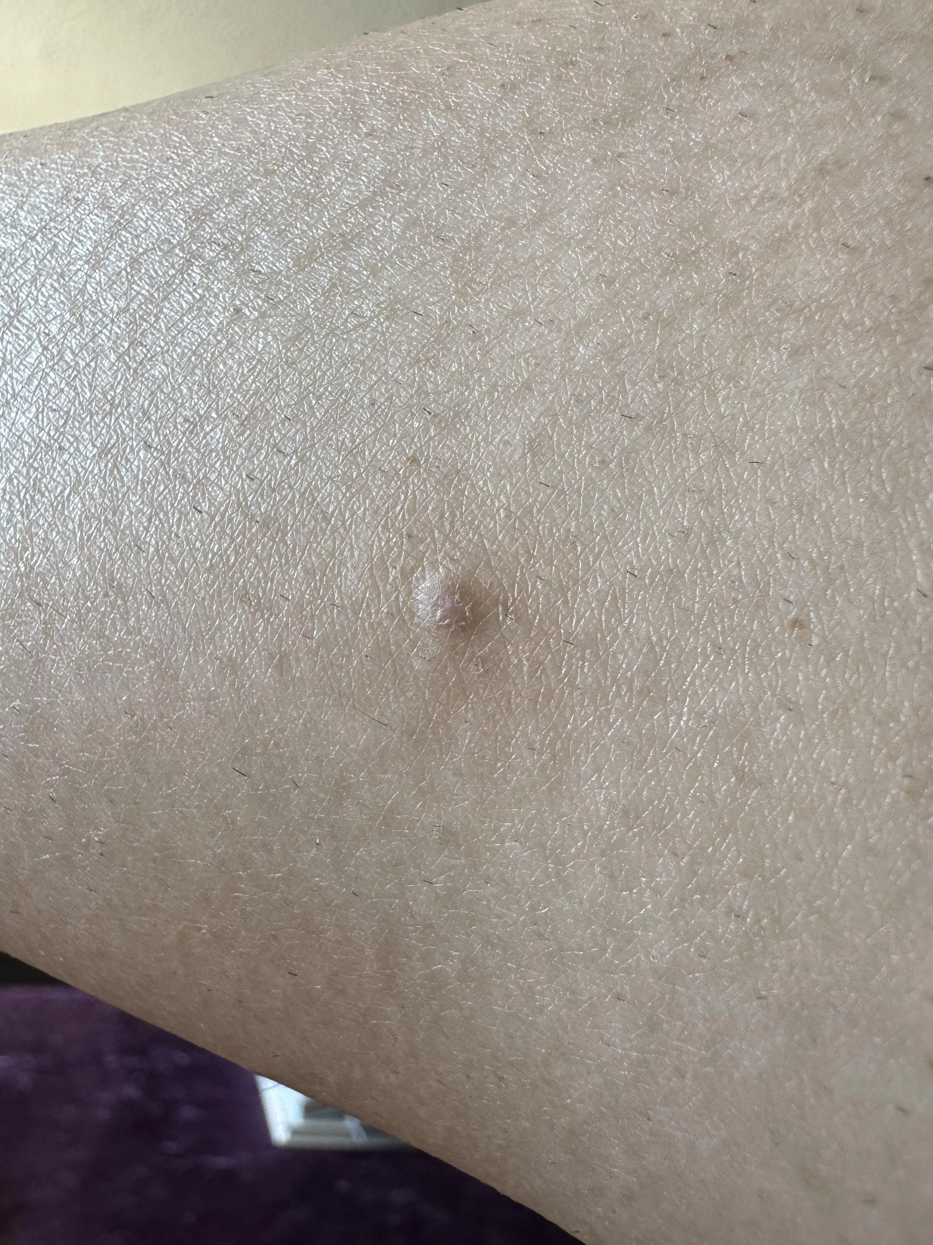 What is this? Ingrown hair?