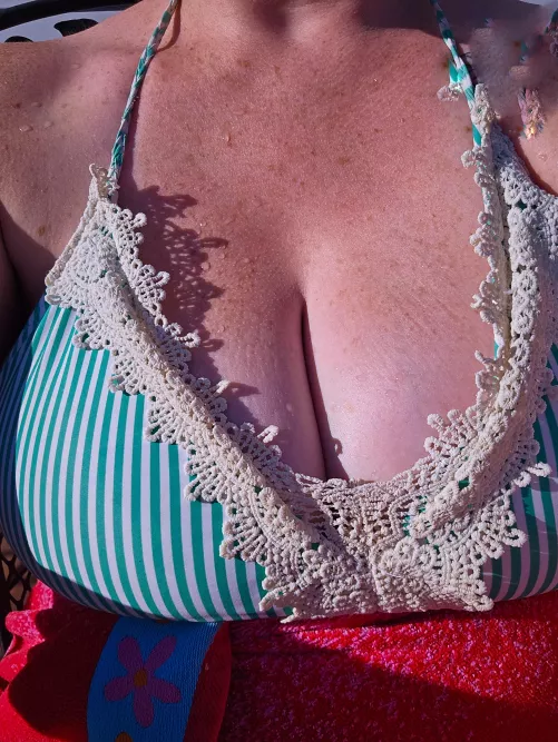 More freckles on top of sunburn. Who wants to help with some aloe? [IRTR]