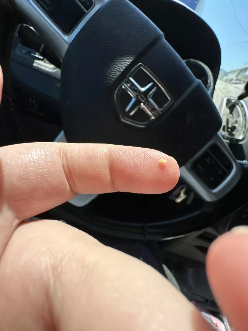 Blackhead in nostril