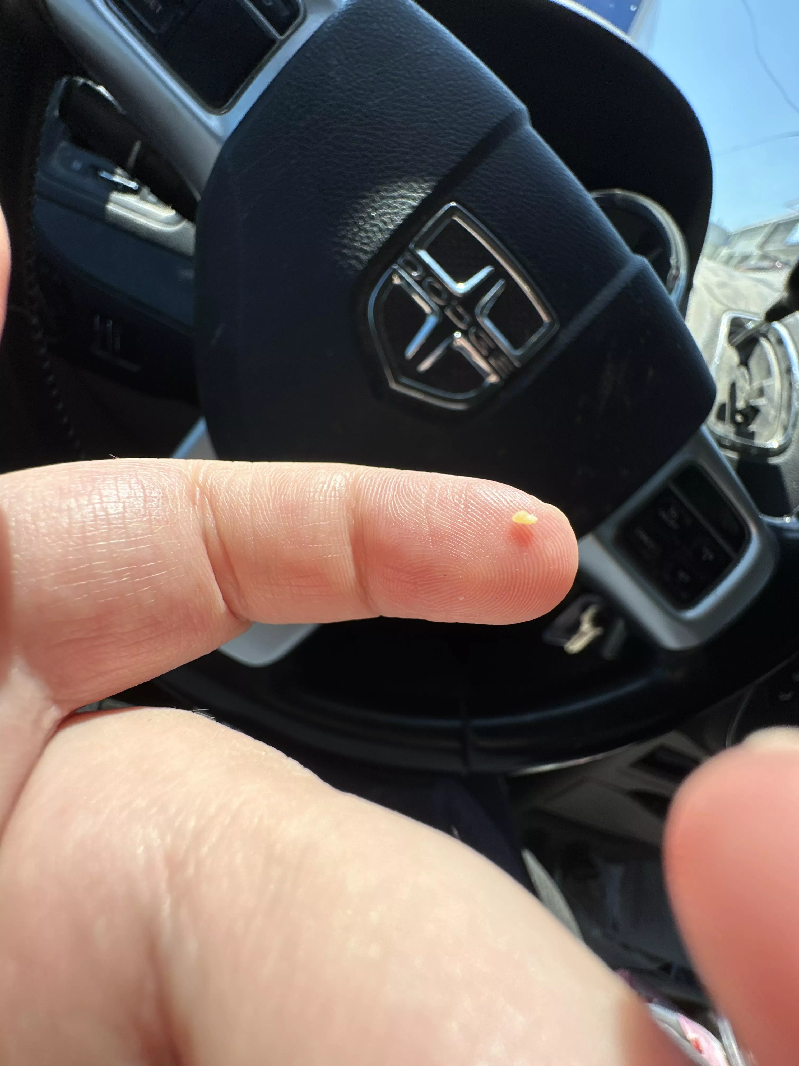 Blackhead in nostril