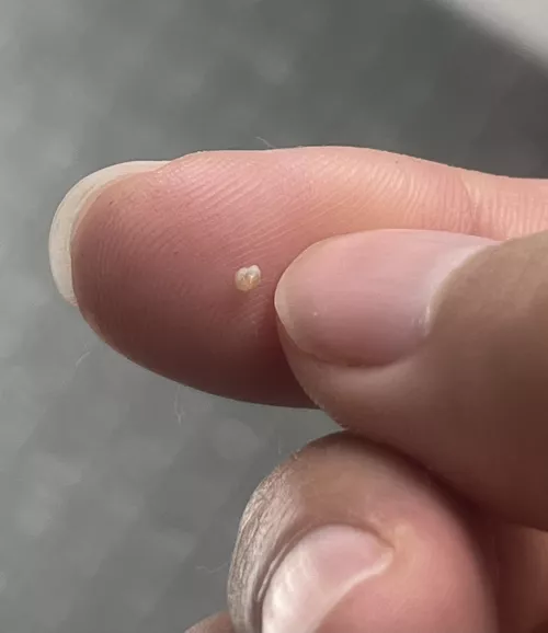A very satisfying seed that I squeezed out of a bump on my armpit