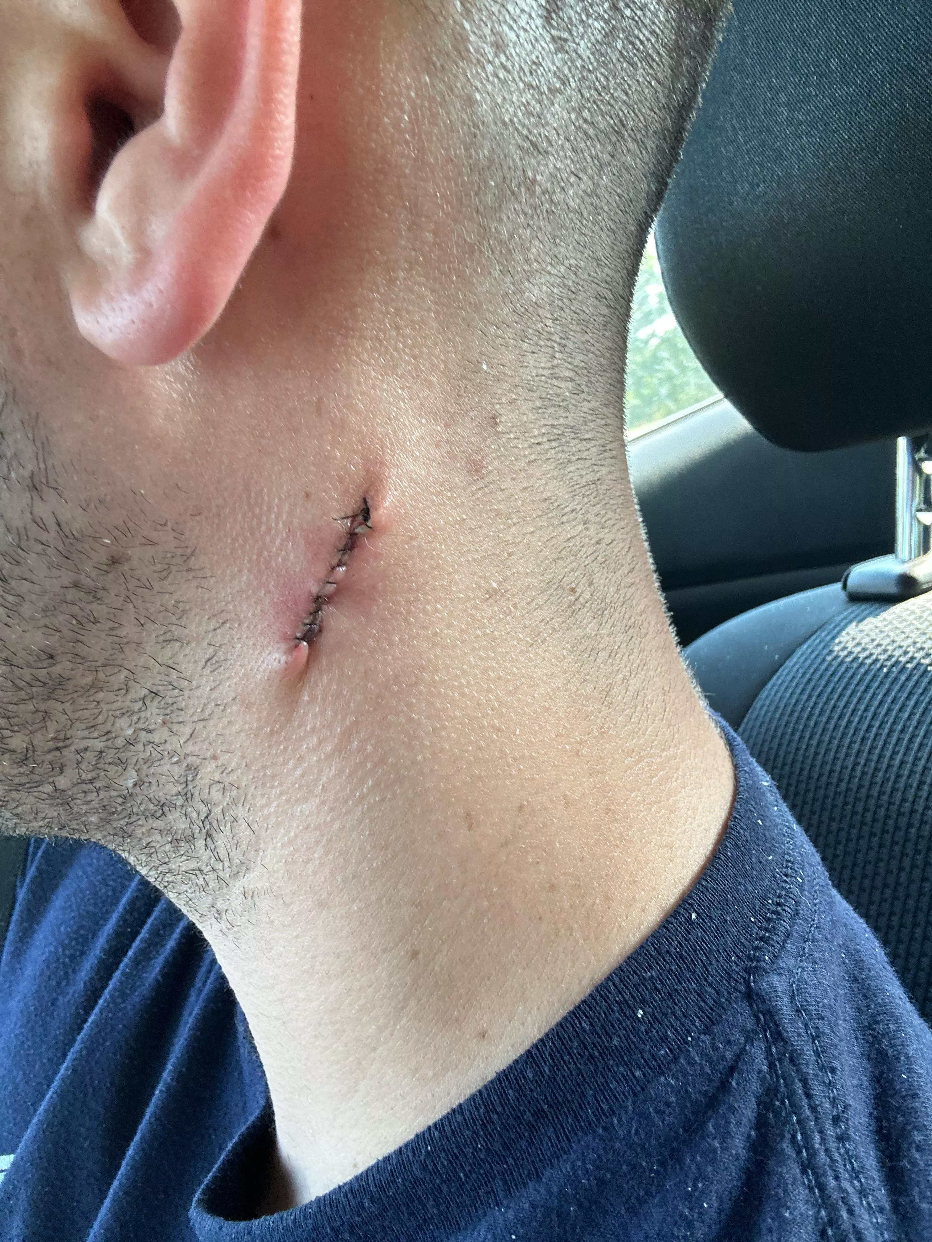 Finally had my cyst removed.
