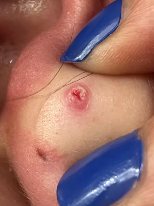 My 4 year old lobe piercing popped!