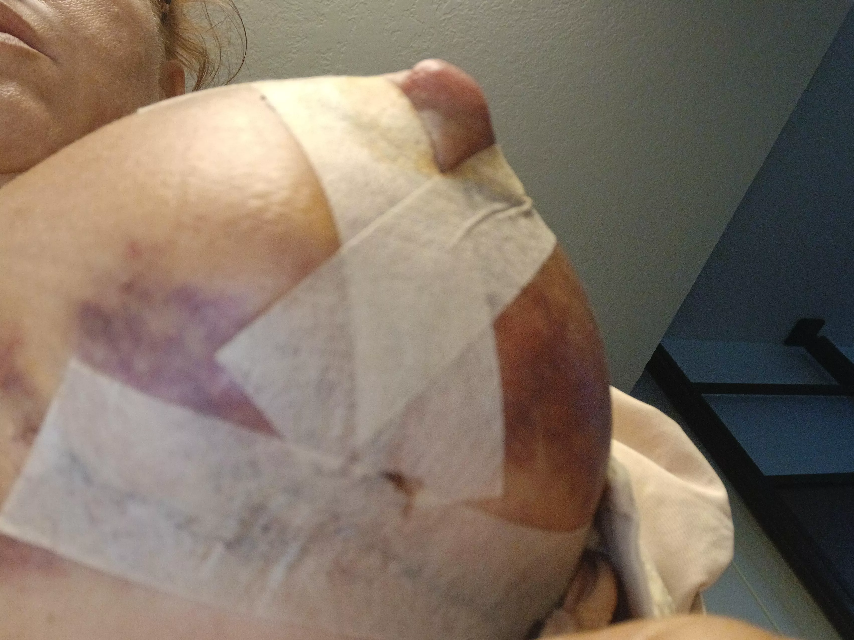 I have some nipple necrosis now im seeing this under boob , normal brusing?