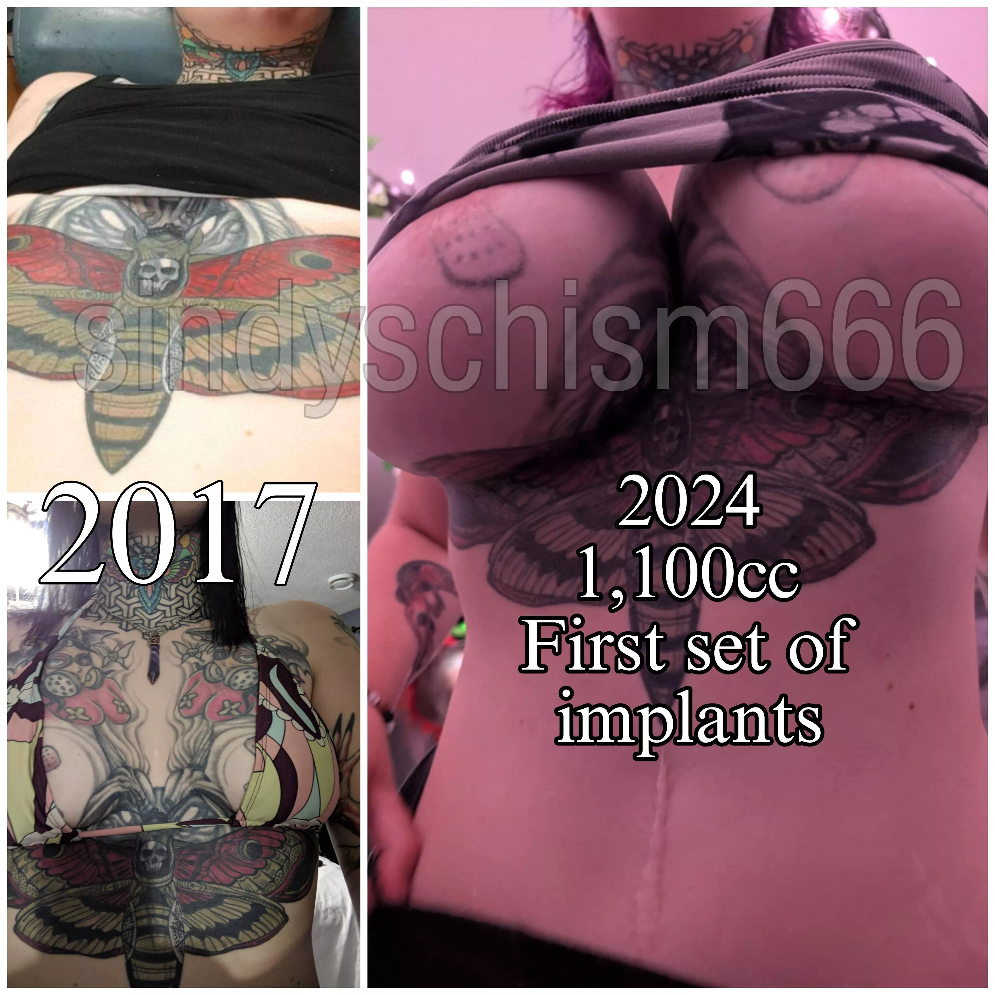 2017 vs 2024 1,100cc implants first set. The top photo I was barely an A cup. The bottom I was a little heavier so I had more boobs. Now I'm a 32N cup. Hoping to double 🙏🏻