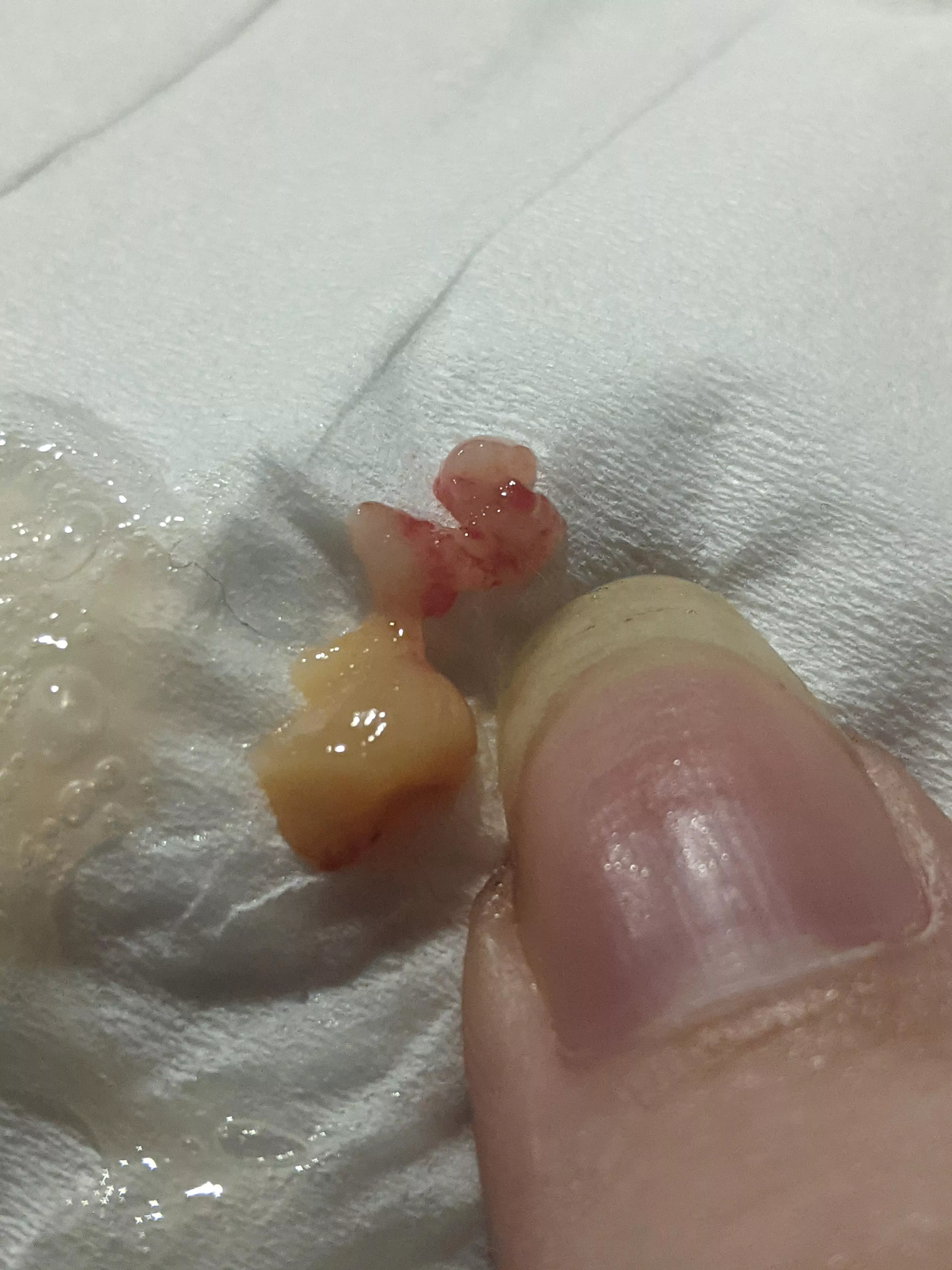 blew a nasal polyp out of my nose. was surprisingly immensely satisfying 