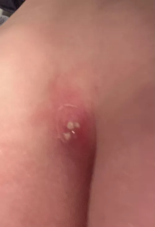 Came home from work to see my cyst now looks like this. Applying warm compresses hoping I can soon provide you with some content. 