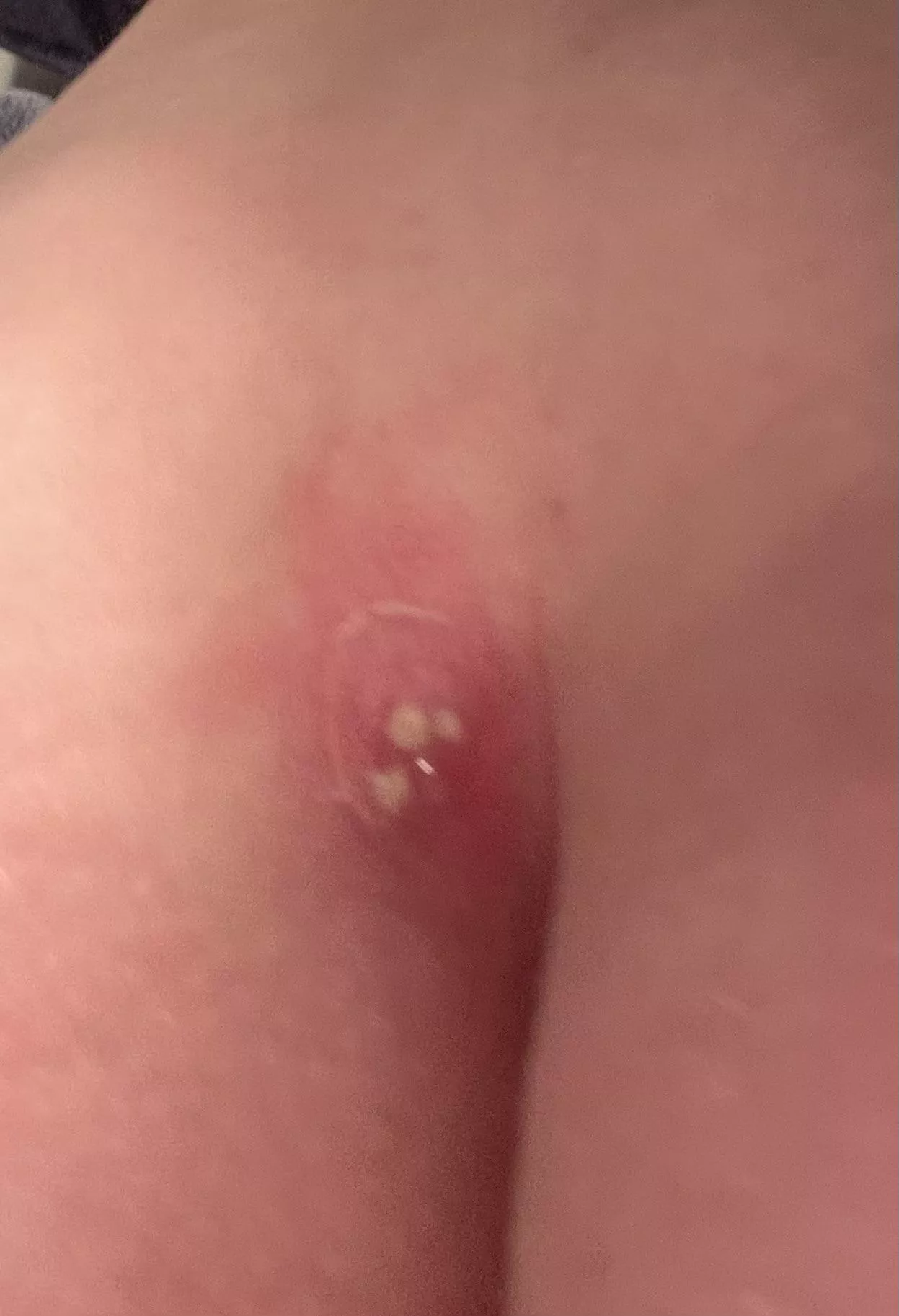 Came home from work to see my cyst now looks like this. Applying warm compresses hoping I can soon provide you with some content. 