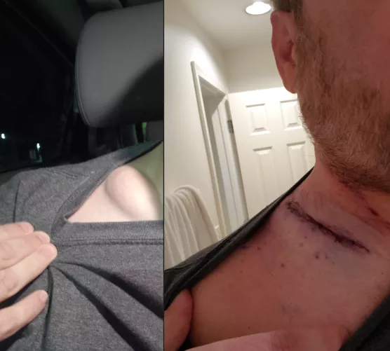 Finally had this cyst removed