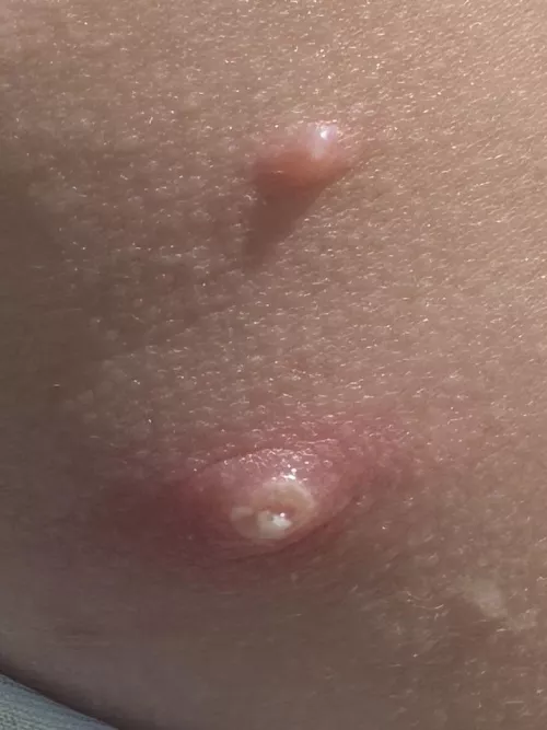 Forbidden pop on an apparently reoccurring rash 