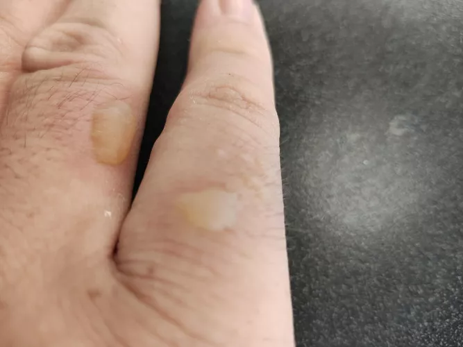 Forbidden pop on these burns! I'm hoping they don't pop at work today 