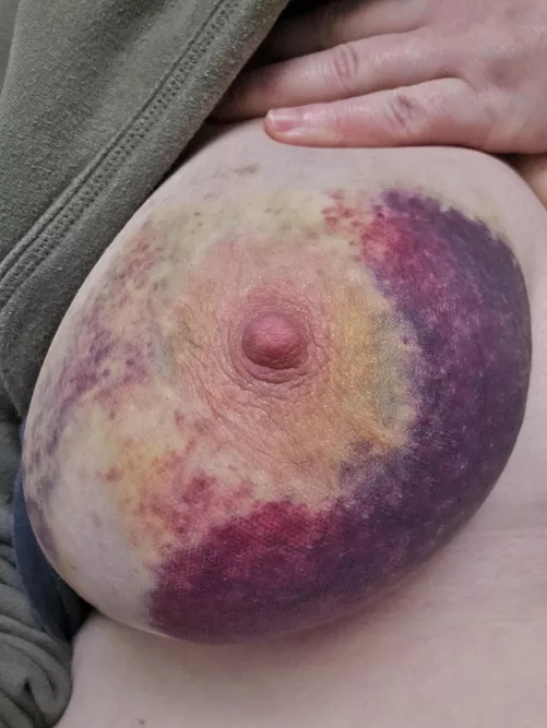 Day 3 bruises from a breast impact session 