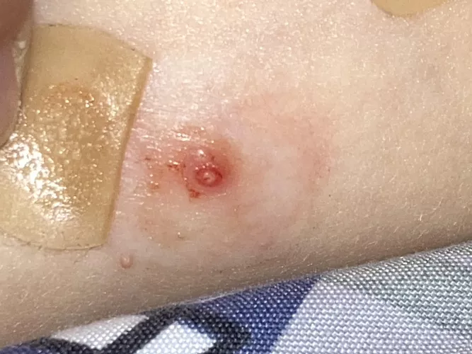 Forbidden Molluscum Pop