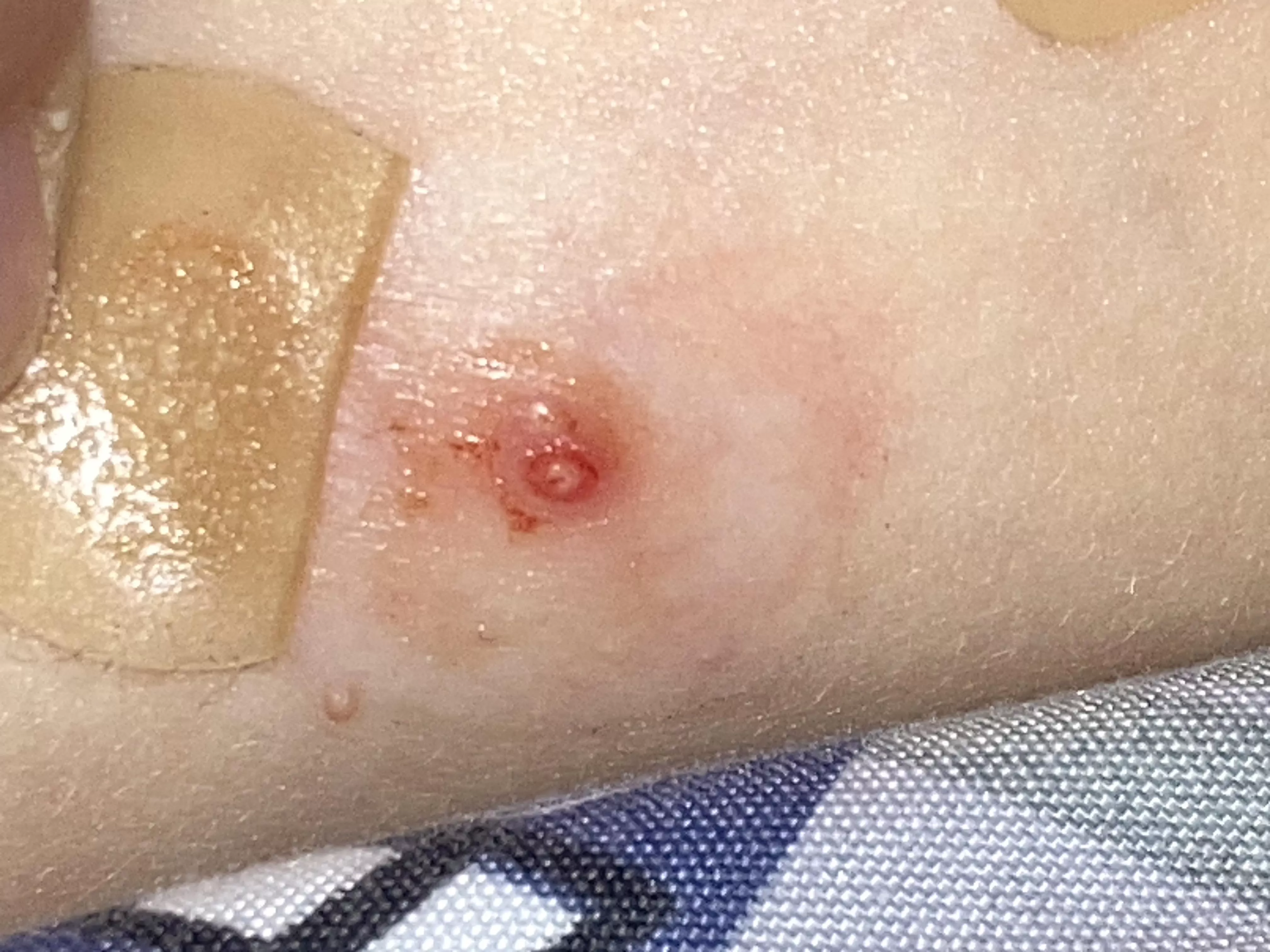 Forbidden Molluscum Pop