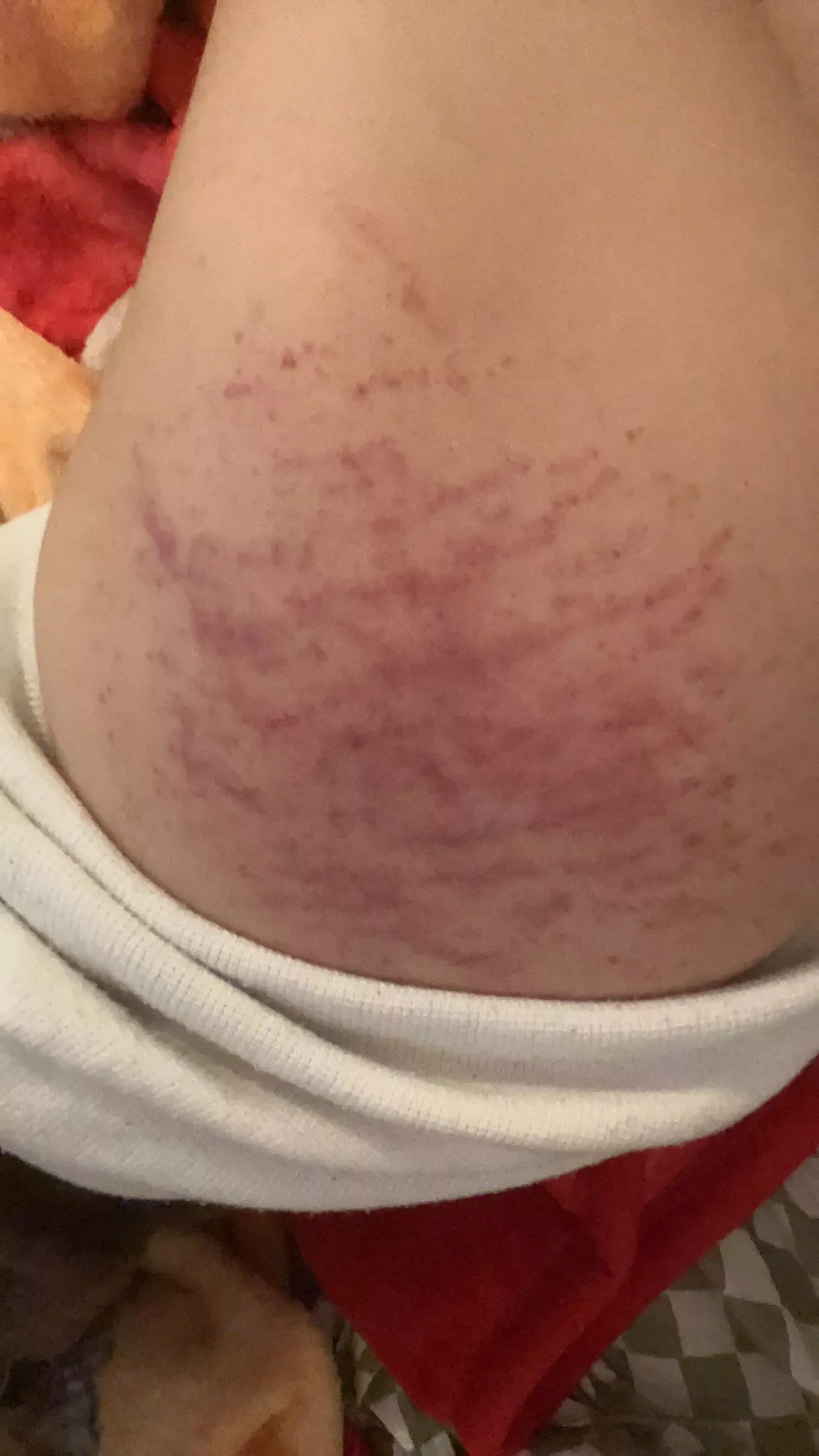 How to get rid of bruises quick