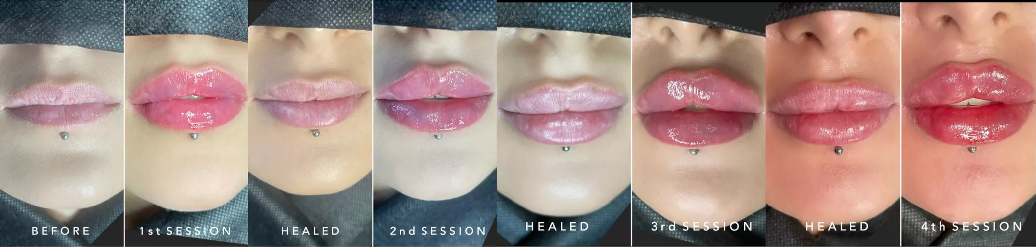Realistic building of lip filler over 2 years