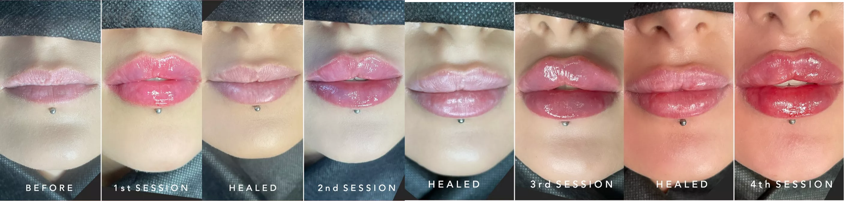 Realistic building of lip filler over 2 years