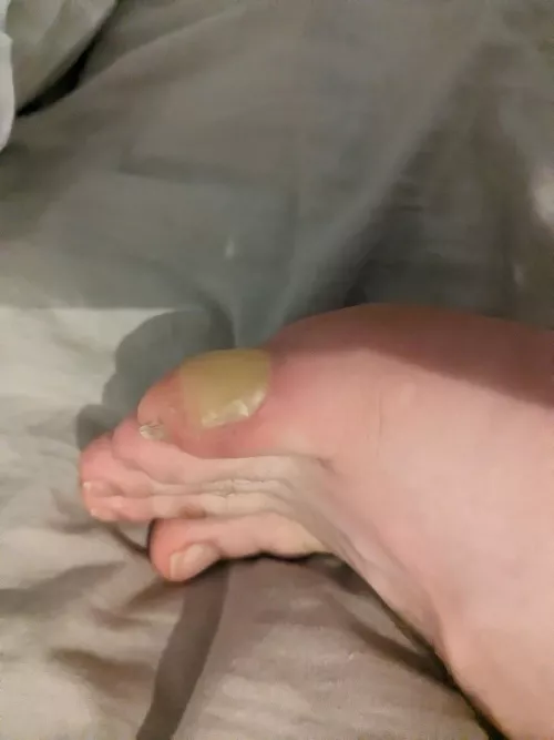 Yellow around blister. Could this be infected?

I was playing football for the first time in many years and I got a blister on my foot.  It was healing fine at first, but I decided to go last week again on a training session and it has gotten worse. He