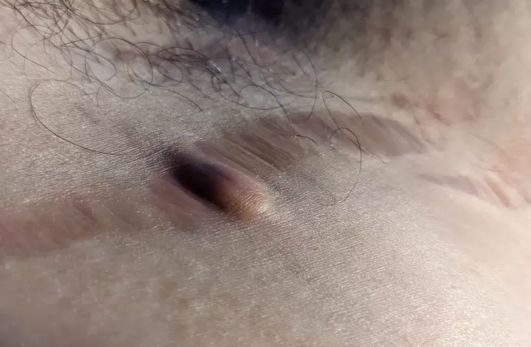 A hair is trapped in my stretch mark 