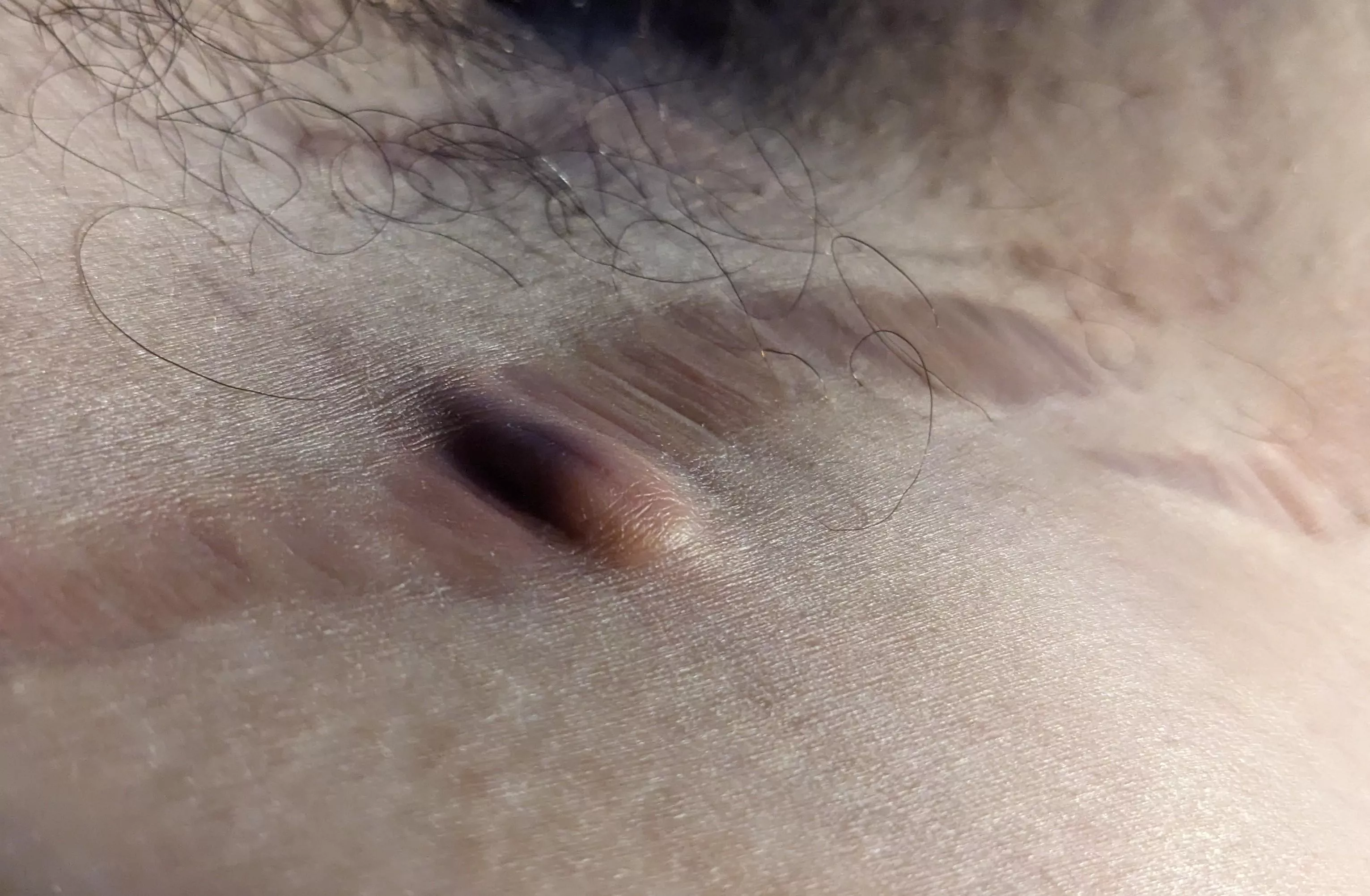 A hair is trapped in my stretch mark 