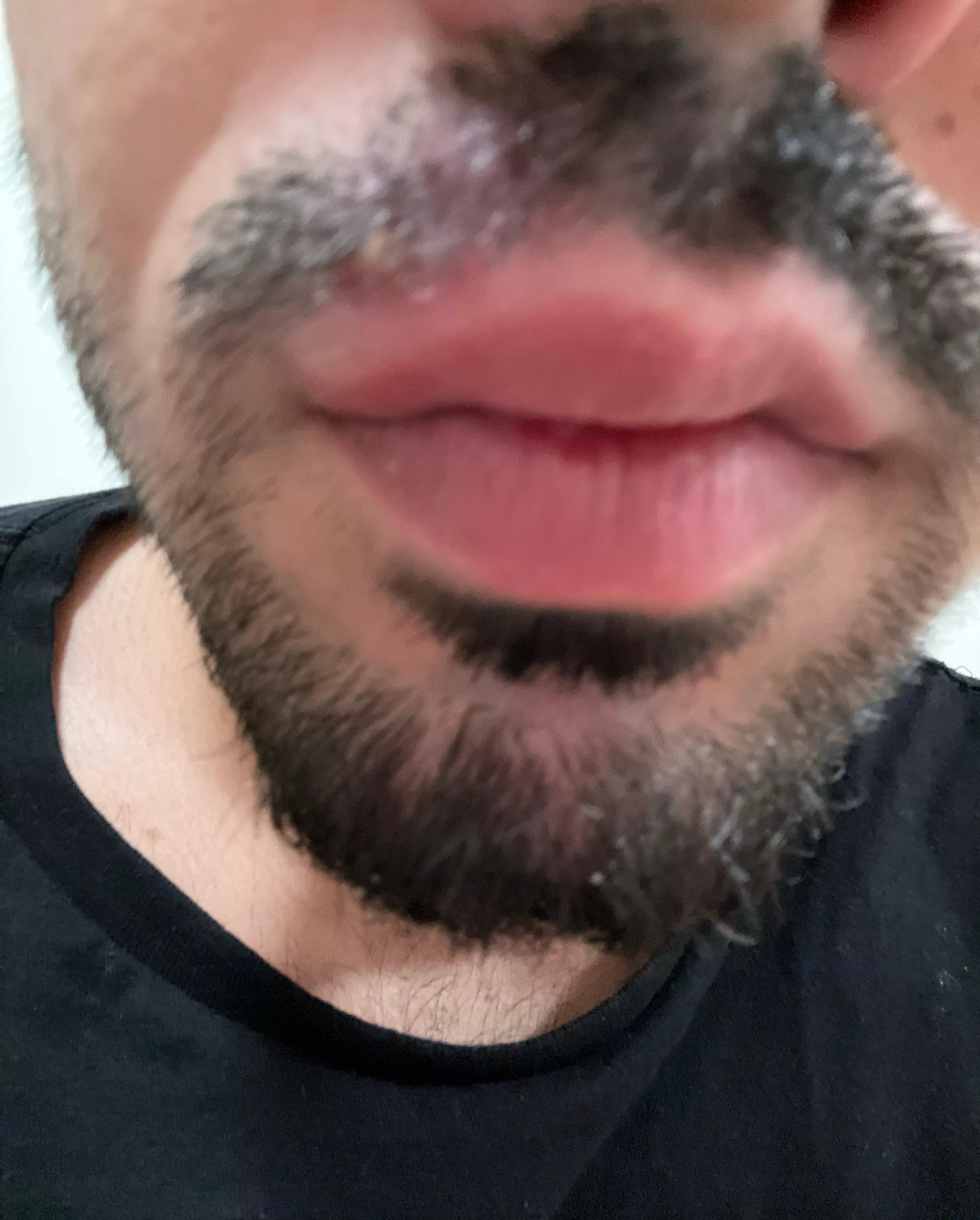 Mustache pimple flare now I have a swollen lip on one side