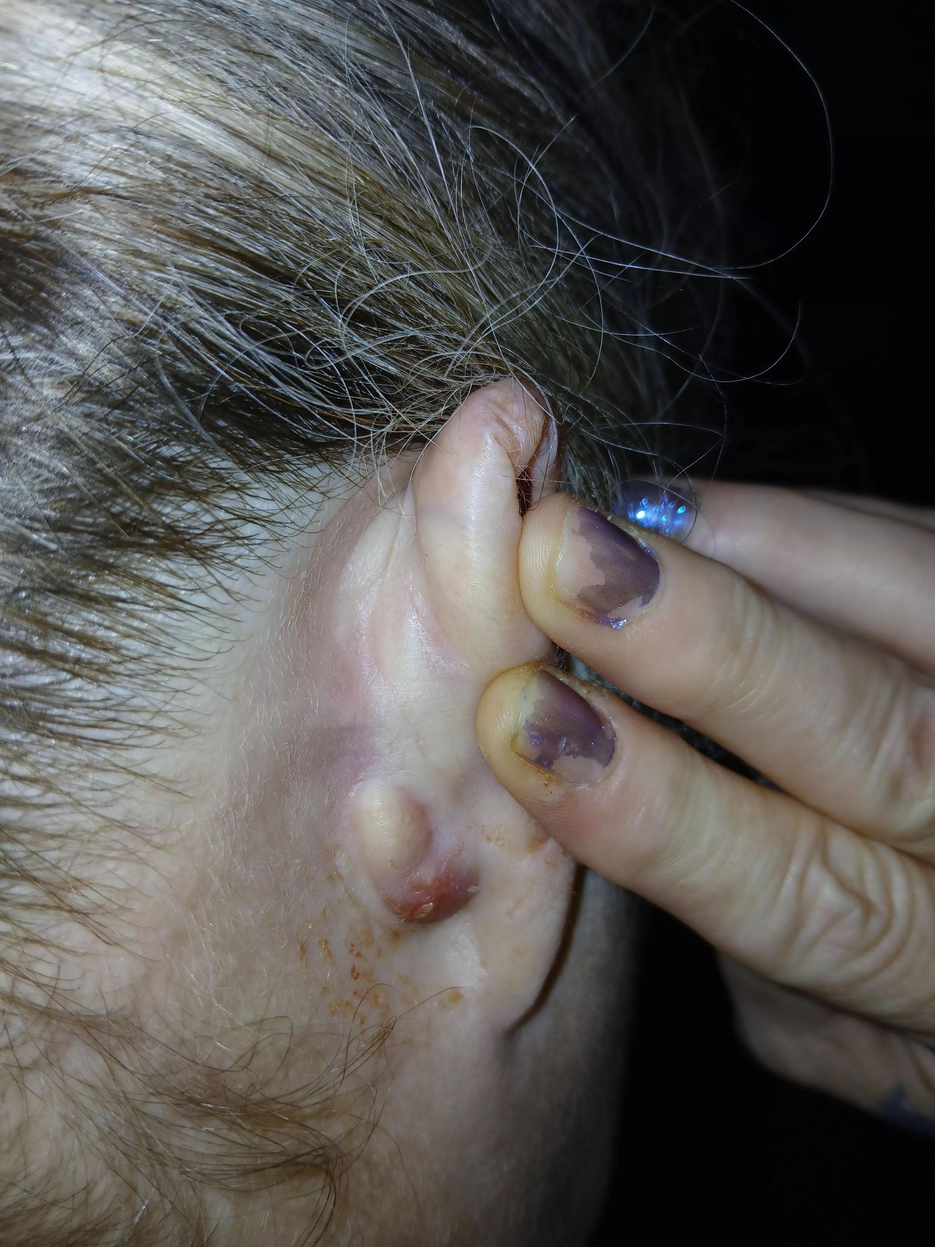 My cyst broke during the night