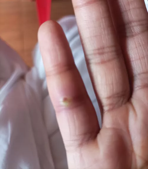 Yellow pus popped under skin