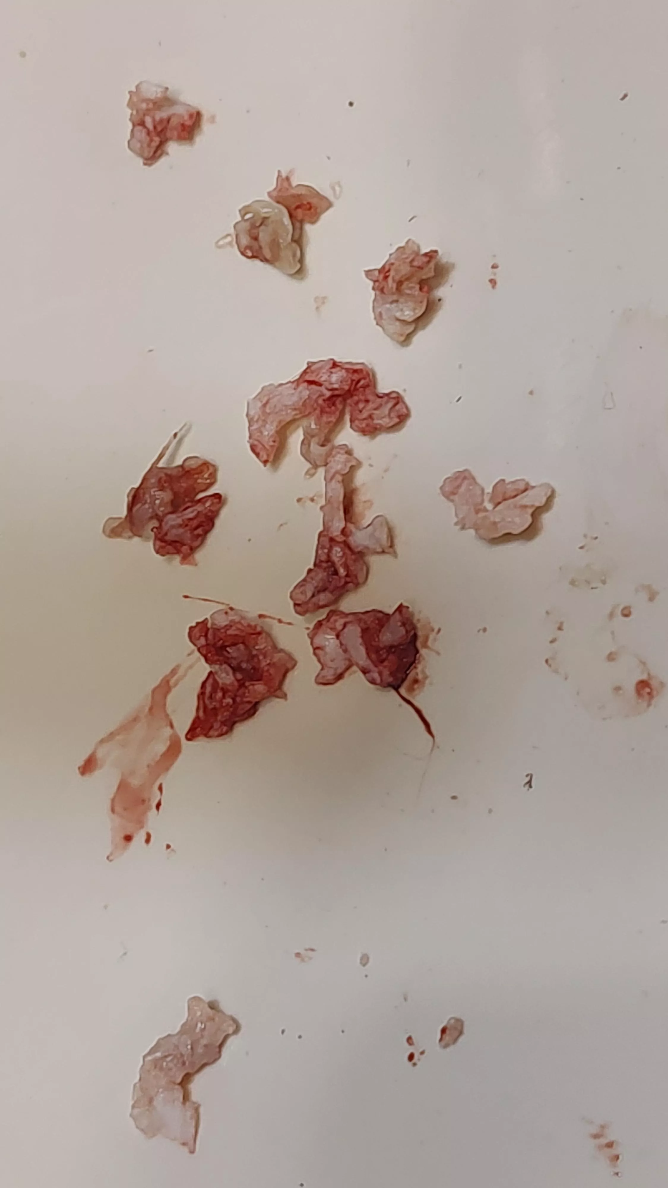 Got all of this out of my armpit cyst tonight