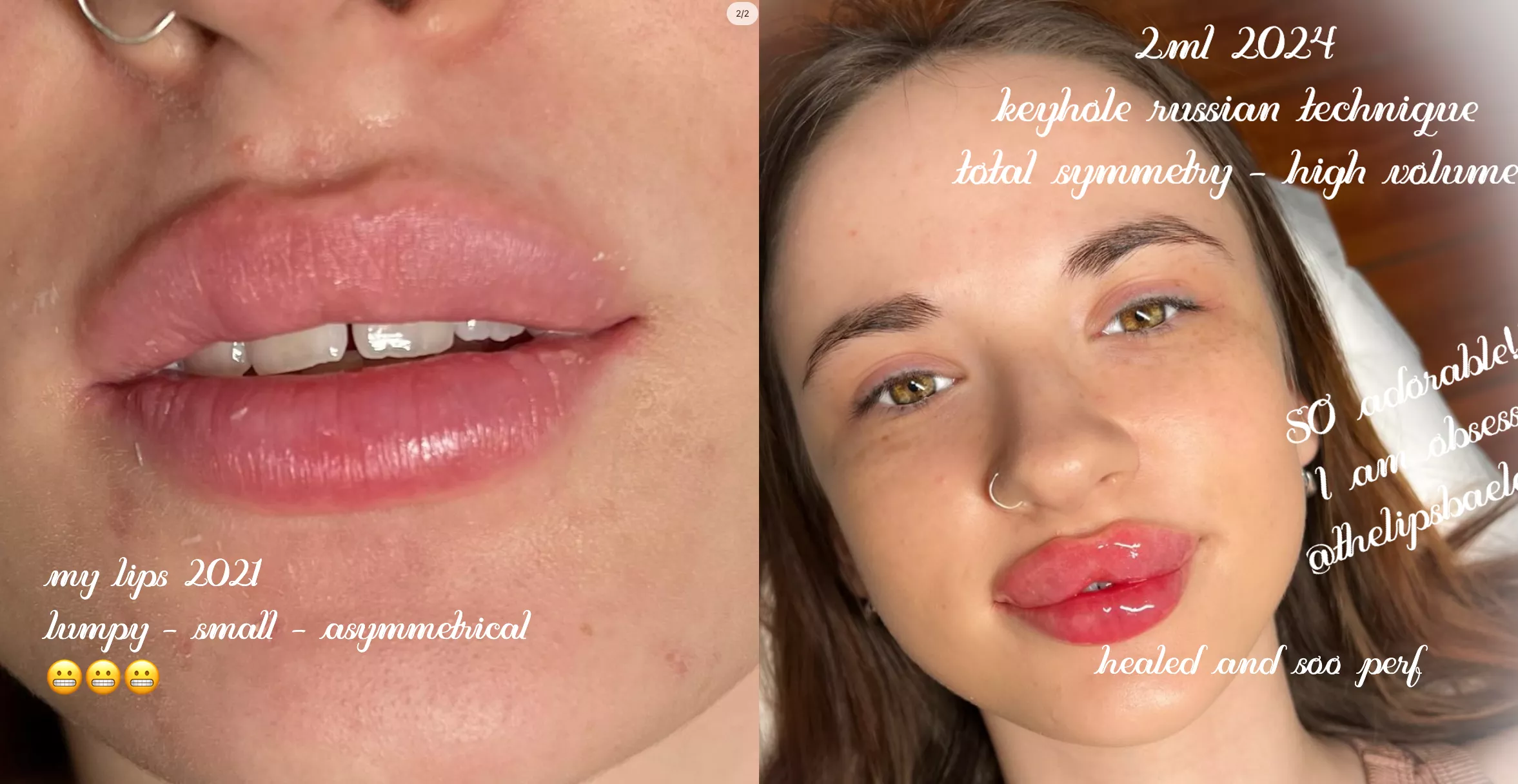 Lip filler influencer on IG