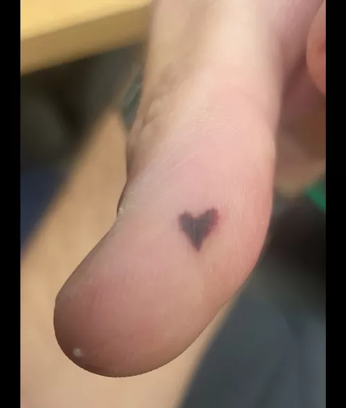 Heart shaped blood blister
