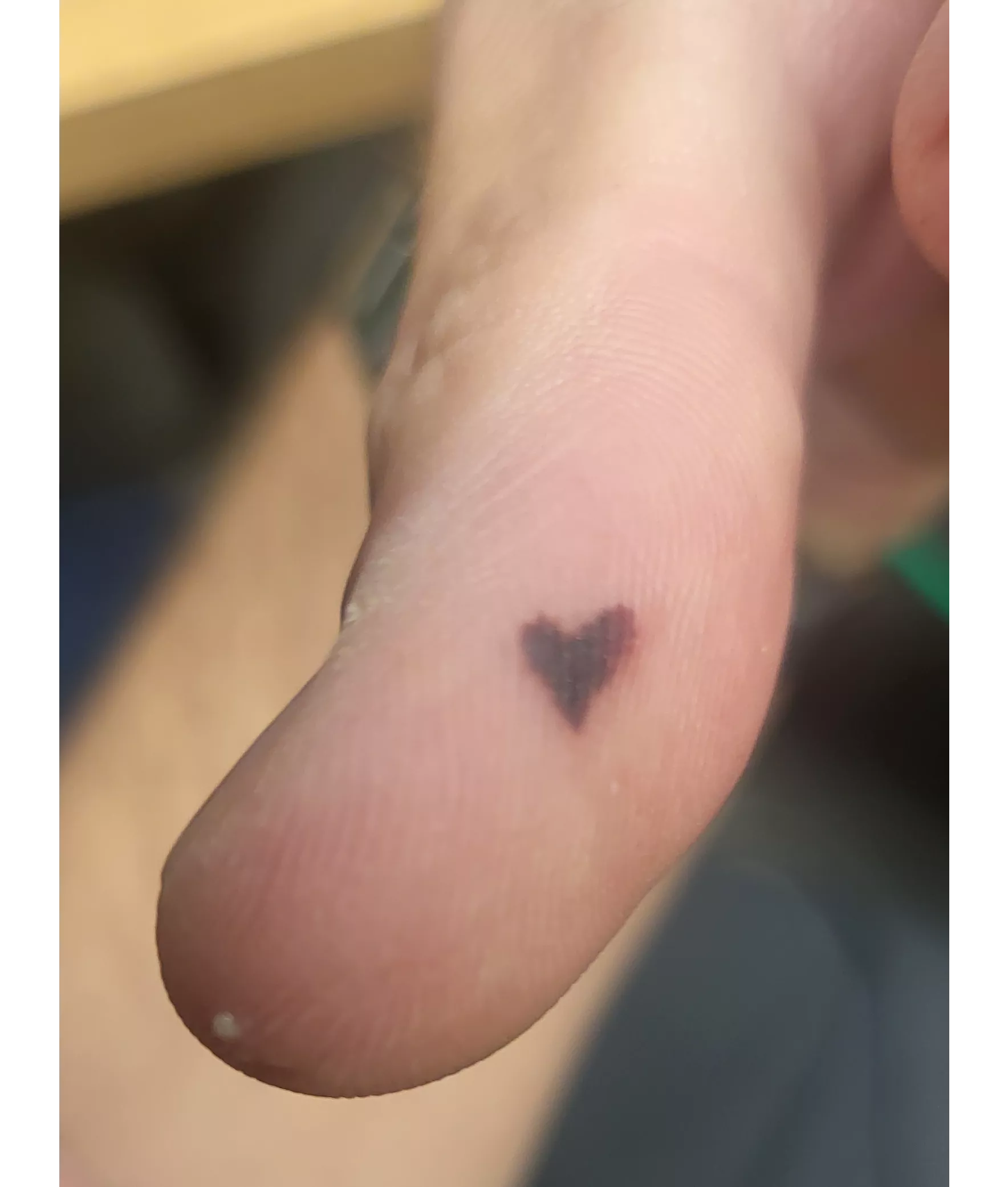 Heart shaped blood blister