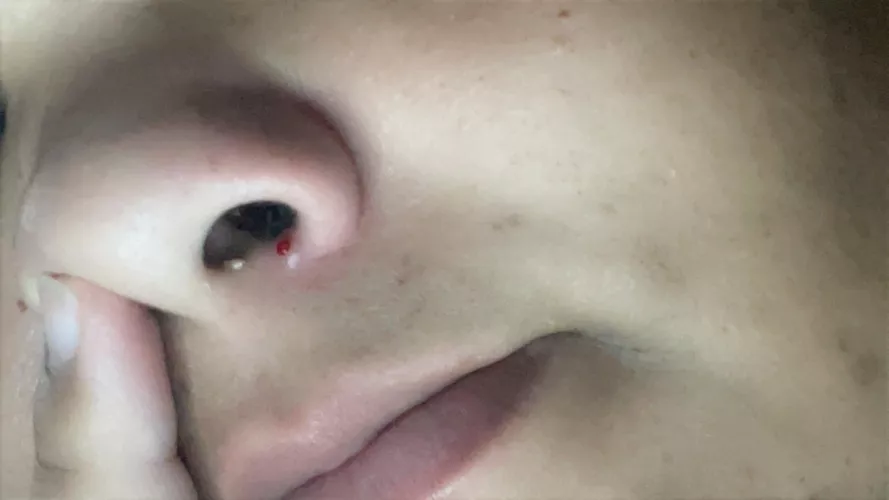 I had this painful one for 3 days and it was just blood so I thought it was a blister. Oops.